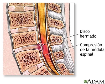 Hernia discal: qué es esta lesión vertebral, causas y tratamiento