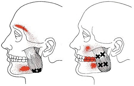 Dolor en la mandíbula y el oído: causas y tratamientos