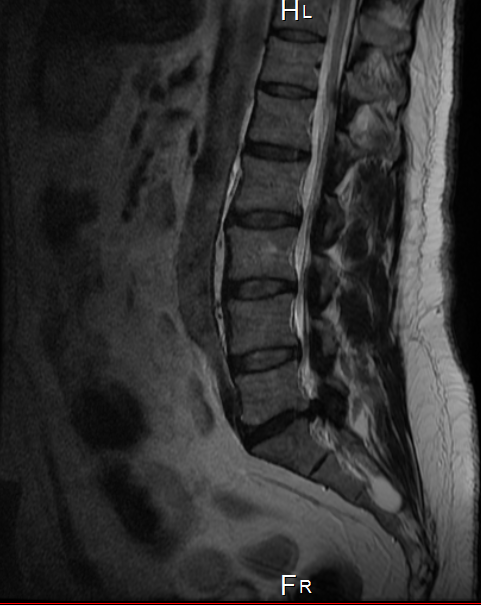 Lumbalgia: Radiografías y resonancia magnética. ¿Está siempre relacionado el dolor con las pruebas?