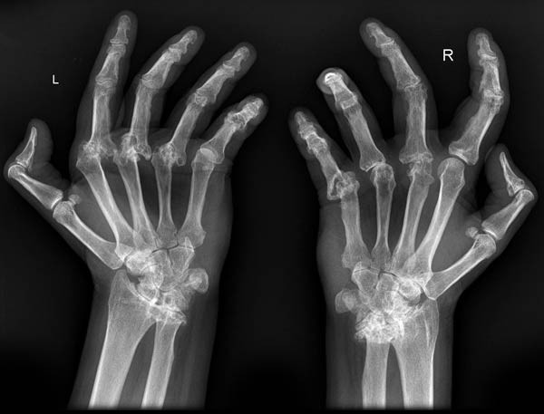 principii de tratament al artrozei deformante durere în articulațiile mâinilor dimineața