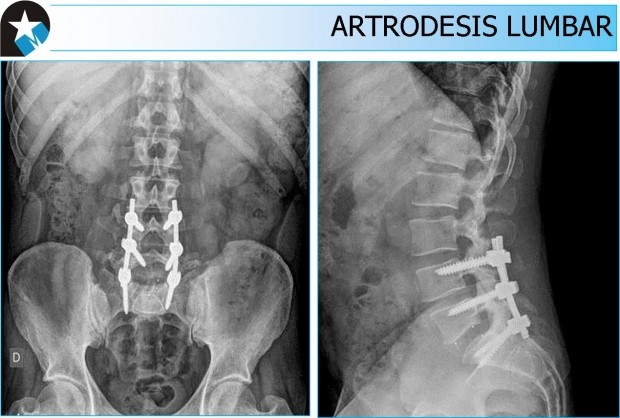 Caso clínico artrodesis lumbar