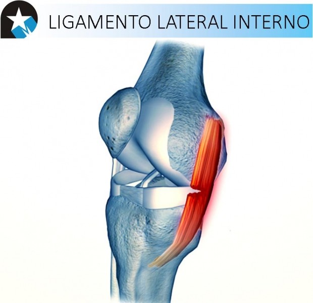 Recuperación de ligamento lateral interno