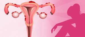 endometriosis-blog
